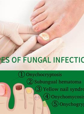 Chrysotile care liquid gray fingernails for hand and foot na