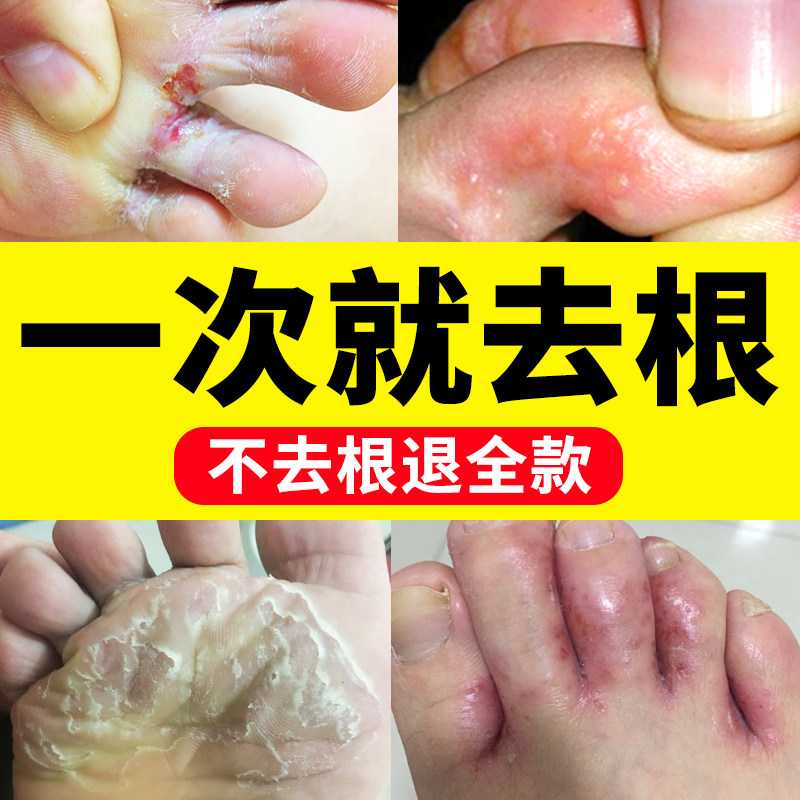 脚干裂脱皮真菌感染苗家药膏止痒专用脚气真菌水日本治鲜药擦手脚