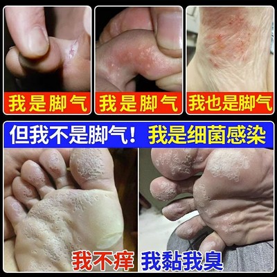 脚臭脚底脚干裂脱皮真菌感染脚日本脚起水泡脚后跟手脚开裂药膏