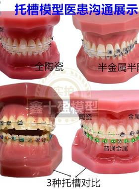 牙科正畸模型全口陶瓷金属自锁红色正畸L医患沟通矫正练习托槽