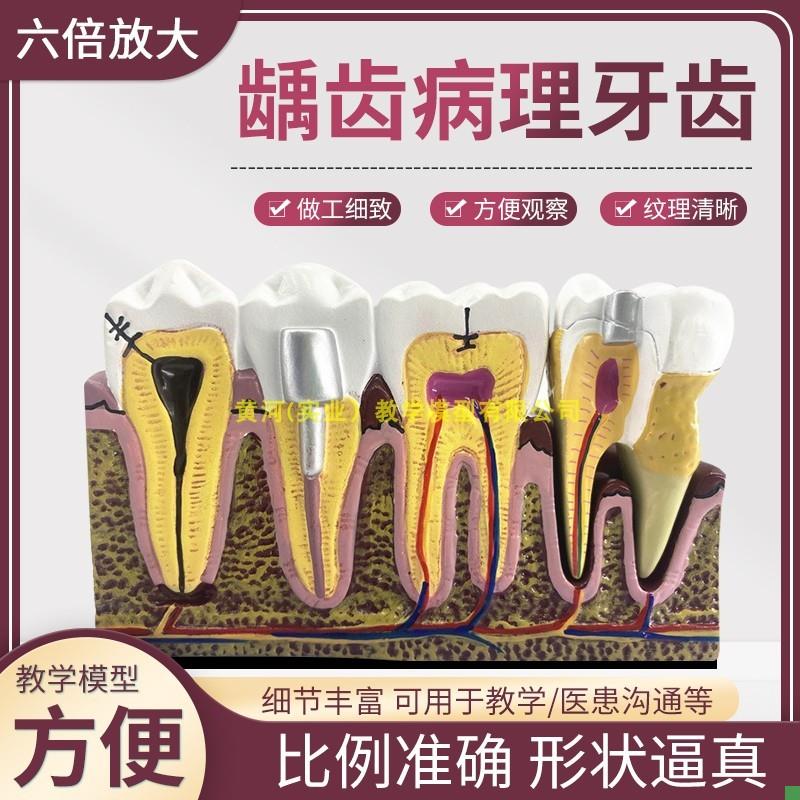 综合龋齿病e理模型牙神经牙模牙科模型牙齿模型口腔模型牙模型牙
