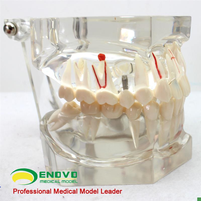颐诺正品牙齿模型2倍透明牙体病理模型口腔科病V理模型医患模型