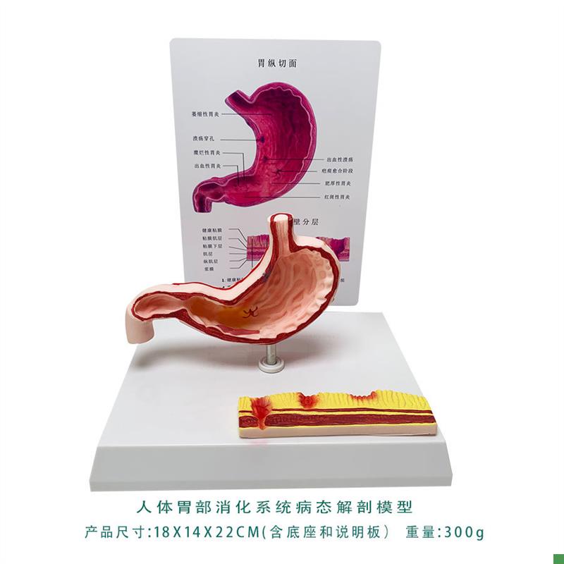 胃病态结构模型萎缩胃炎溃疡穿孔人G体消化系统模型人体解剖教具