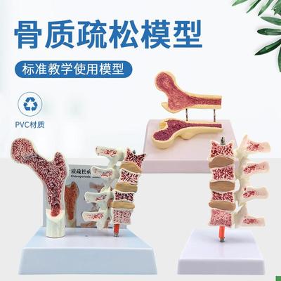 人体股骨骨质疏松解剖模型腿骨解剖面脊柱切面标V本病变腰椎模型