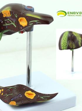 ENOVO颐诺乙肝肝炎脂肪肝肝硬化肝脏模型消化科医学Y肝胆保健模型