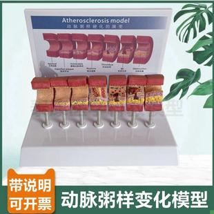 动脉内膜受损模型血管阻塞脂肪斑块粥样老年人心血管冠.状动脉狭
