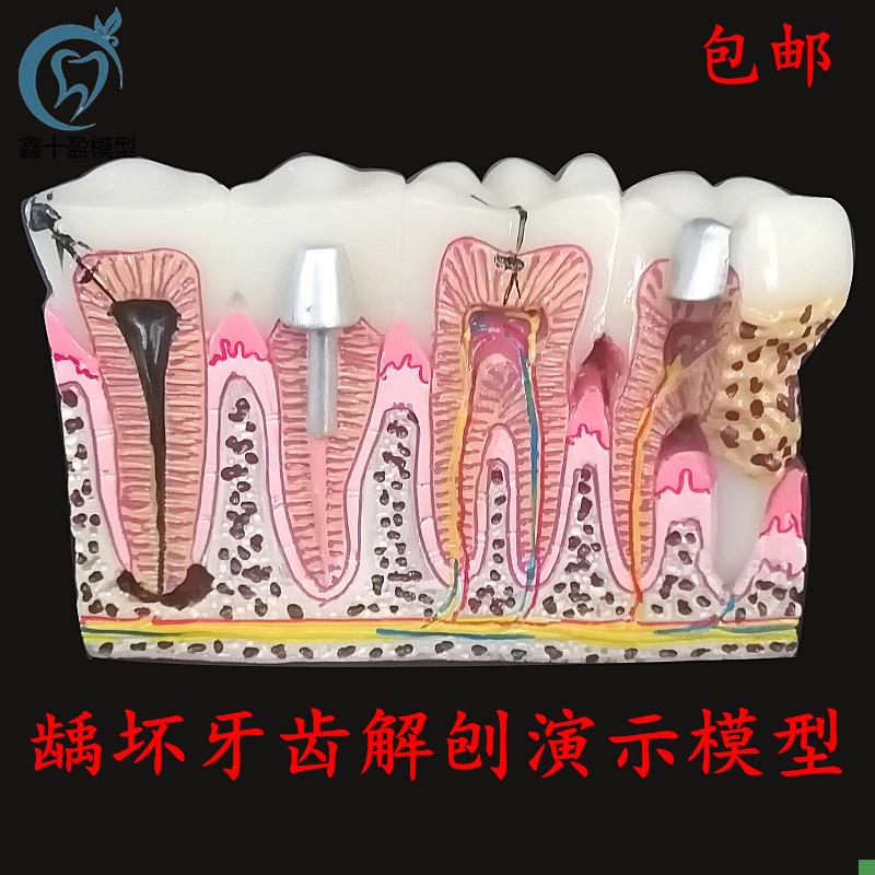 牙科牙周综合理龋齿解刨教学模型病例沟通模型Q解刨面分解4029