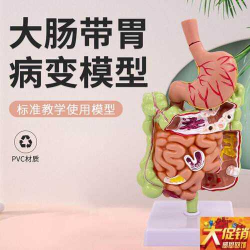 大肠病理模型 肠胃模型 大肠病变模型 J肠道疾病 人体结肠病变模