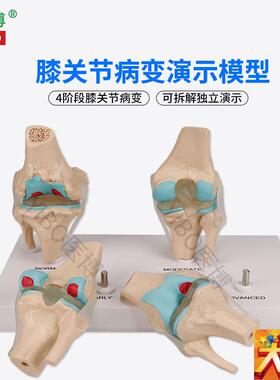 医博BIX-A35j71膝关节病变模型 人体骨骼病变模型 人体膝关节4阶