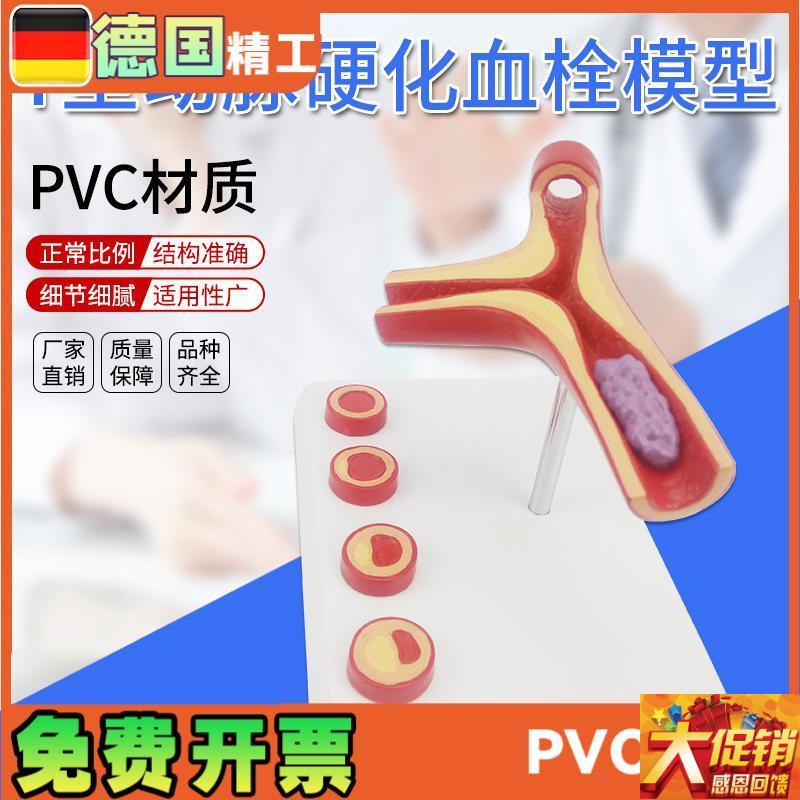德国】Yc型动脉模型硬化带血栓模型人体血管医学教学模具
