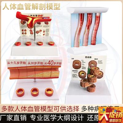 血管堵塞动支脉粥样m硬化心血管动脉硬化模型血管病理动态血栓模