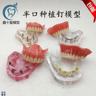 牙科模型医患沟通2四4颗钉种植与修复模型种植钉X球帽杆卡导板