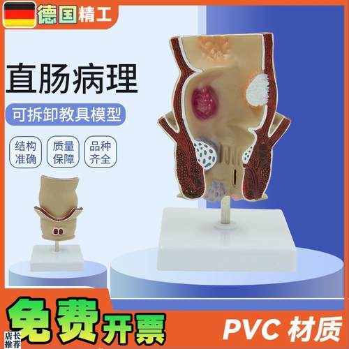 德国】人体直肠痔疮病变解u剖模型结肠肛肠科肛门括约肌教学标本
