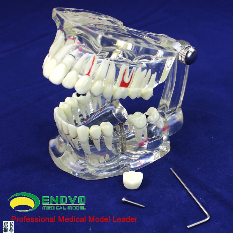 ENOVOc颐诺牙齿模型口腔牙齿科种植模型口腔病理模型种植体牙冠义