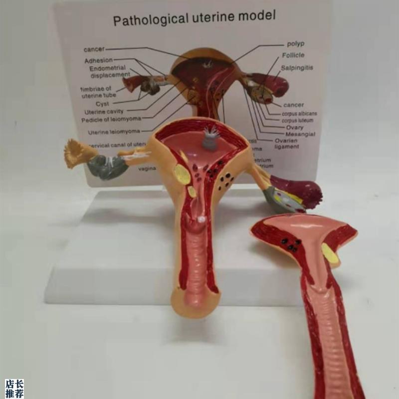 包邮女性病理子宫模型w妇产子宫结构解剖仿真病态子宫