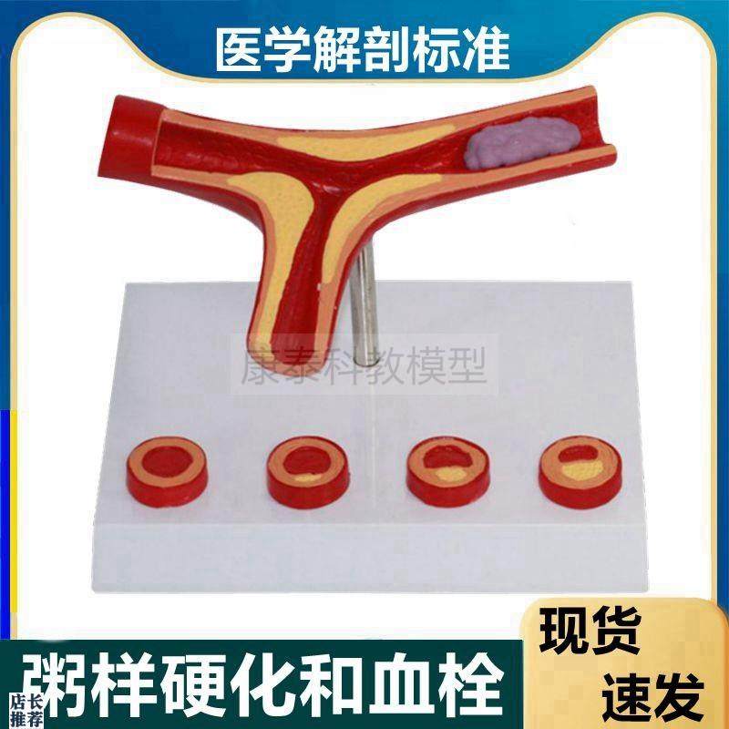 动脉血管模型粥样阻塞硬化狭窄y栓子脂肪斑块病理血管内膜不同年