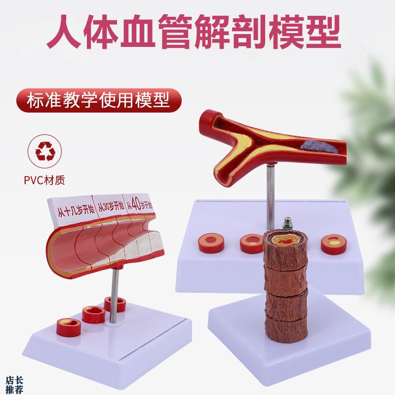 人体血管模型粥样动脉/硬化模型病变血H栓/血管/病演示血管模型