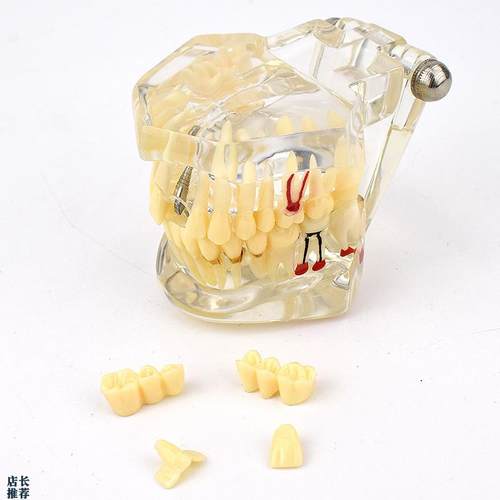 ENOVO颐诺口腔模型齿科种植阻生齿牙体牙髓口腔教学X马里兰桥瓷贴