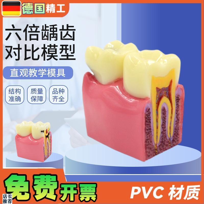 德国】六倍龋齿对比模型s口腔牙齿模型口腔教学蛀牙切面模型牙