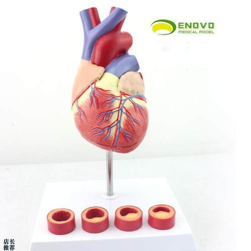 ENOVO颐诺1:1医学人体心脏模型冠状动脉血栓心内科教Z学动脉粥样