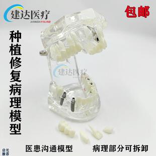 牙科口腔教学模型种m植修复模型病理牙模综合病理连桥病理贴面修