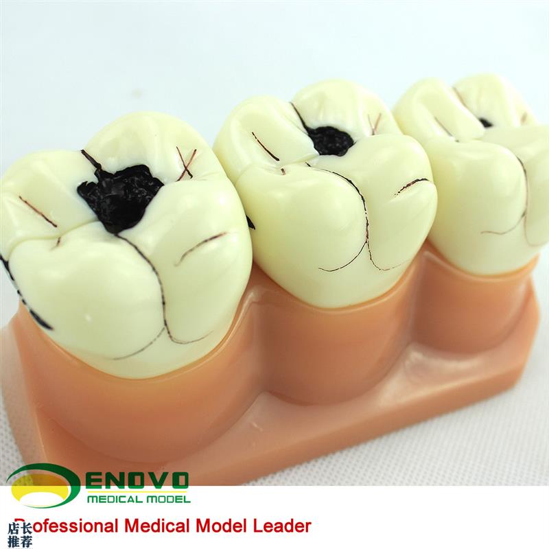 ENOVO正品口腔科牙齿龋齿分解A模型口腔病理龋齿模型医患沟通演示