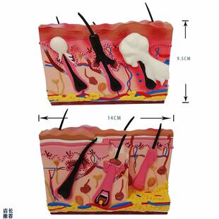 皮肤皮炎湿疹皮h癣疱疹模型痘痘痤疮教学教仪优惠教学医院专用