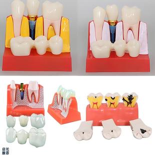4次种植及解说模型口腔牙齿模型牙冠可移动种O植钉展示模型医学通