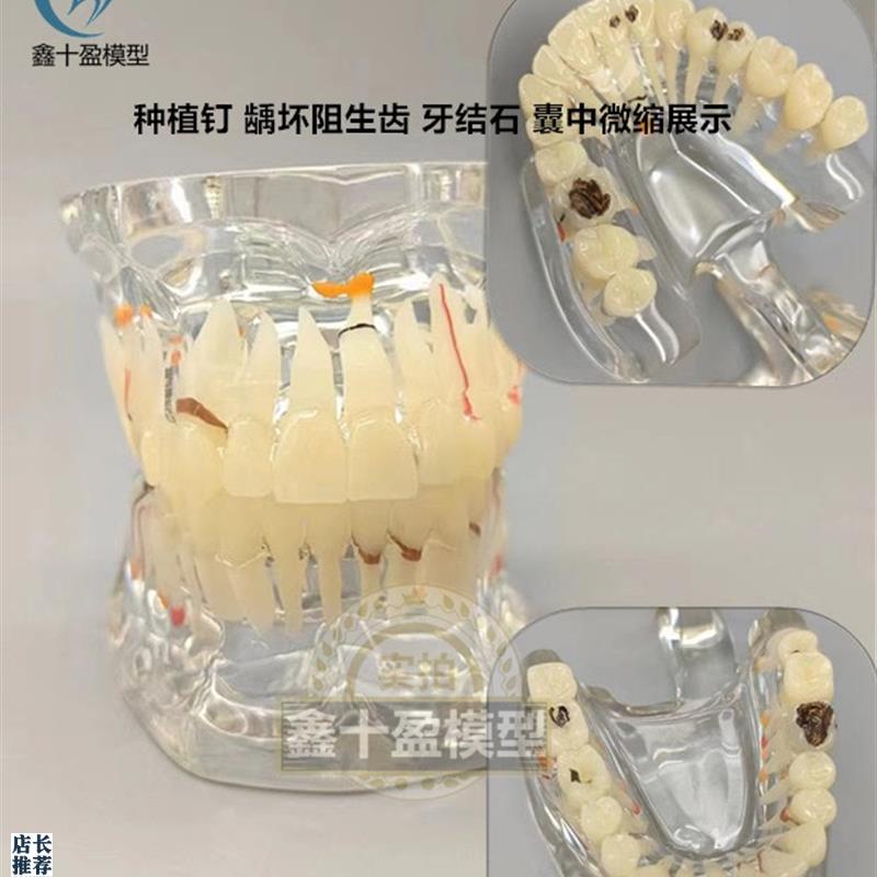 牙科牙齿模型2倍透明牙体综合病理E模型口腔科病理模型医患模型