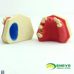 ENOVOe颐诺口腔种植上颌骨上颌窦牙列缺失种植体牙医齿科牙齿模型