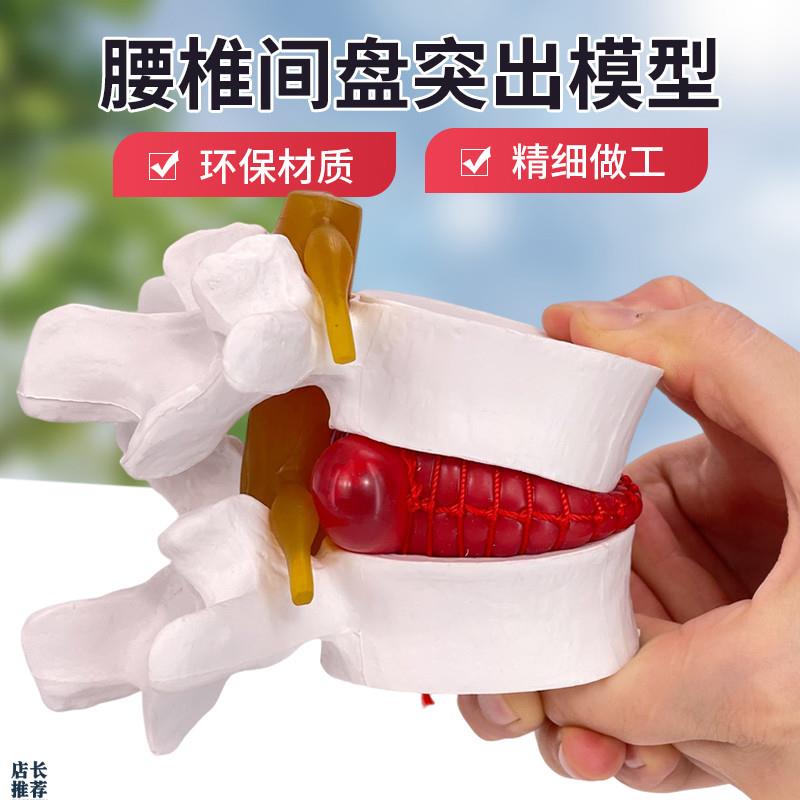 腰椎放大腰椎间盘受压演示模型z人体脊柱脊椎骨病理椎间盘膨出模
