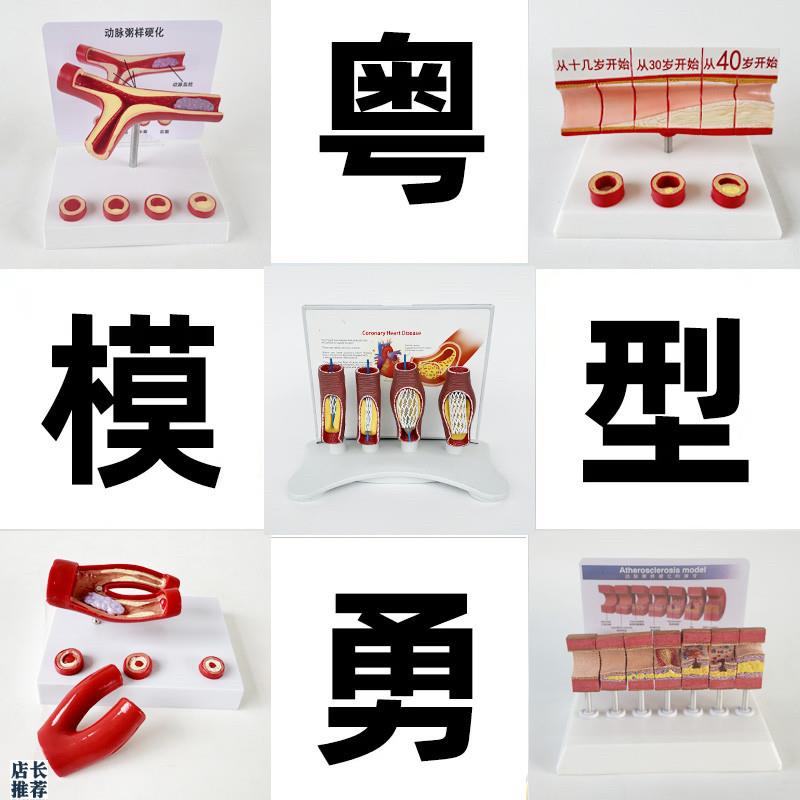 动态血管粘稠堵塞模型动支脉粥样A硬化心血管支架放大病理教学模