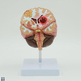 康泰模型脑血管卒中病理畸形动静脉破裂出血中风S神经系统医药促