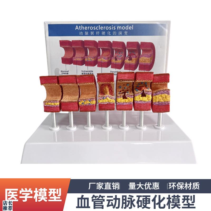 7节动脉粥样硬化模型血管血栓栓C塞演示模型人体血管模型医用教具