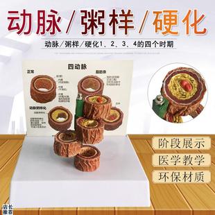 血管/堵塞动支脉粥样/硬化心血管动脉/硬化模型血管病.理模型血栓