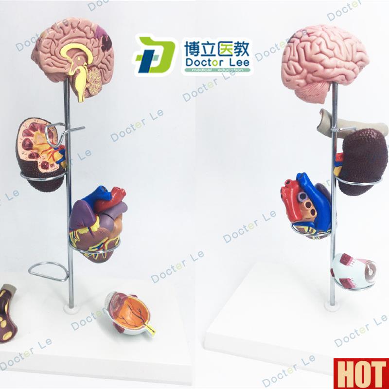 口人体高 血 压 模型 并发症 心脏模型 肾脏模型眼睛K模型脑模型