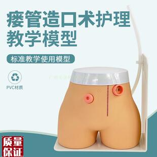 造口模型高级瘘管造q口术护理模型结肠回肠造瘘教学模型造口