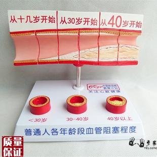 人体支脉粥样硬化和r血栓形成模型人体模型病态血管模
