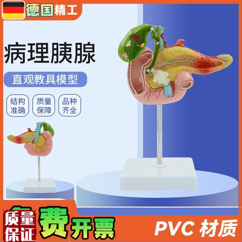 德国】教学仿真病变p胰脾肝胆十二指肠模型病理胰腺标本胰脾