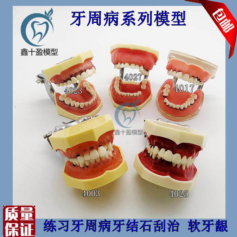 牙科口腔教学模型牙周病理模型练H习刮治结石牙周分类医患沟
