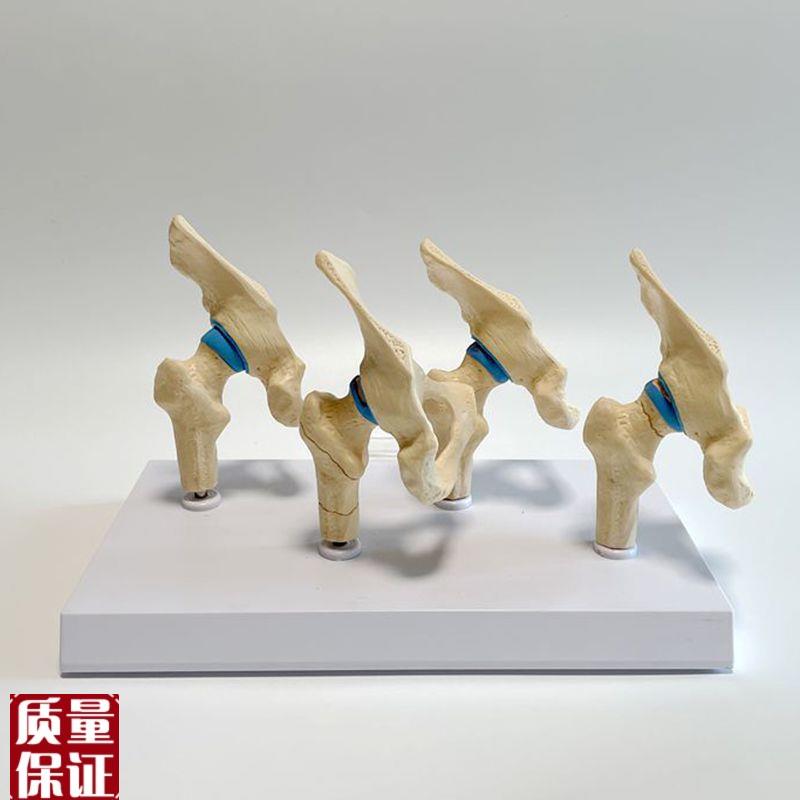 髋关节模型股骨颈骨折软骨损伤四个G阶段股骨头缺损骨科医药促销