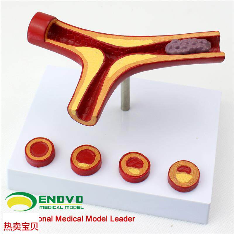 颐诺正品冠状动i脉性心血管动脉硬化模型老年心脏模型血栓形成