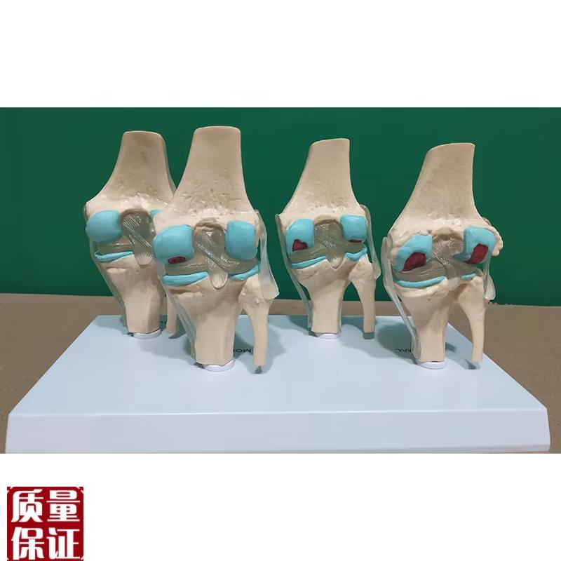 人体膝关节模型4阶段半月板软骨韧带病变劳P损骨人工假肢医患演