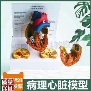 病理心脏模型颤动心房临床医患沟通人I体心脏解剖瓣膜冠状动脉心