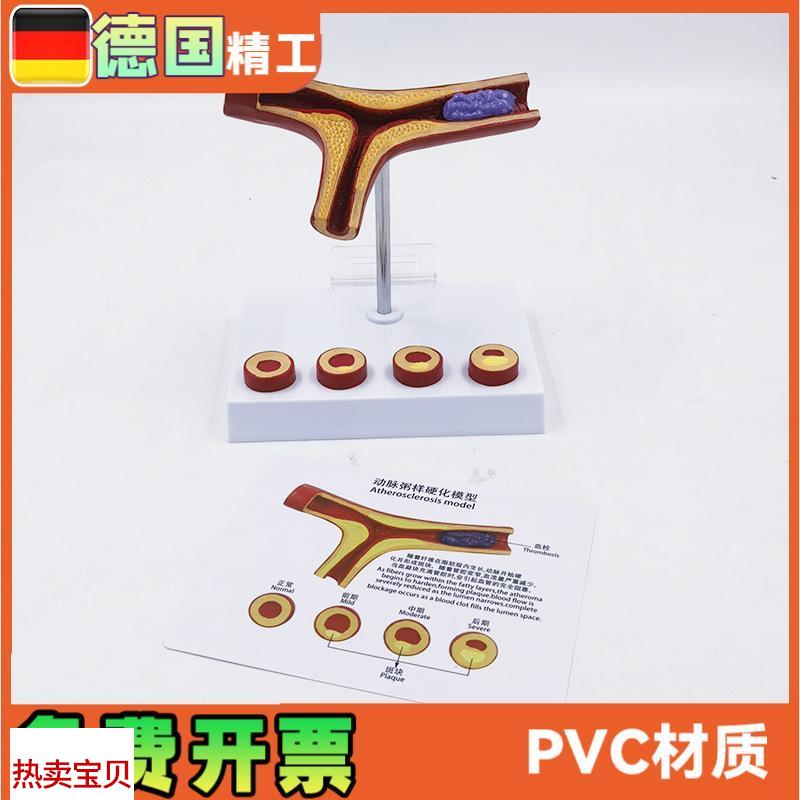德国】动脉模型血栓冠心血u管解剖教学医药礼品健康管理教具医学