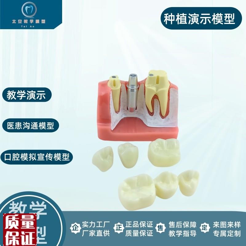 牙科口腔b种植模型演示模型医患沟通教学练习种植牙模
