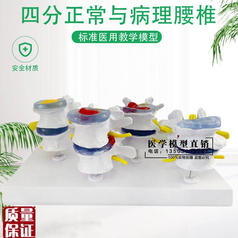 四分型腰椎正常与腰椎及病变组合模型人体骨骼U病理解剖模型关
