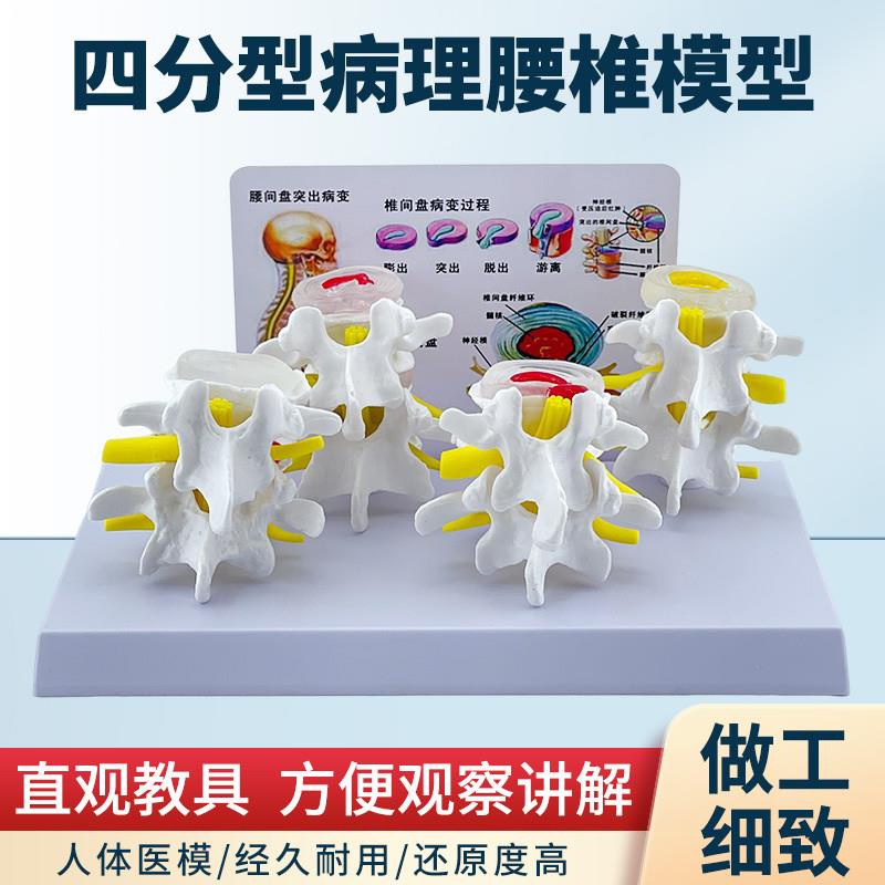 四分型病变腰f椎与正常腰椎组合模型人体骨骼病理骨骼模型