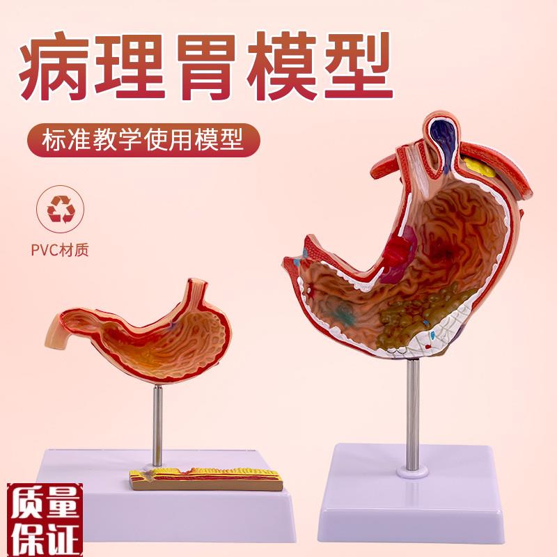病理胃仿真人体胃的穿孔病态胃消化科胃冠状V剖面解剖放大模