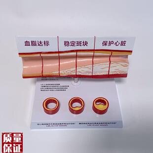病理心血管模型粥样硬化脂w肪斑块动脉内膜受损程度医药促销礼